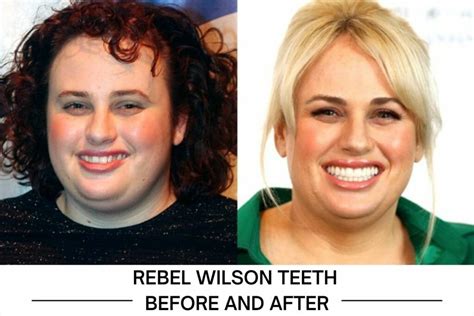 are rebel wilsons teeth fake